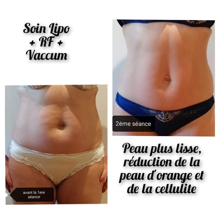 Peau plus lisse, réduction de la peau d'orange et de la cellulite